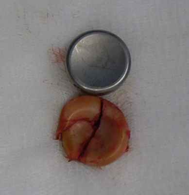 Рис. 5. Компонент эндопротеза