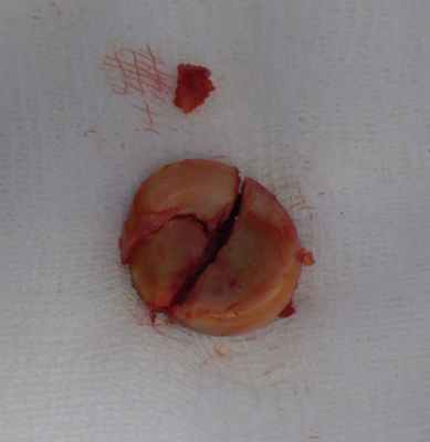 Рис. 4. Многооскольчатый перелом головки лучевой кости