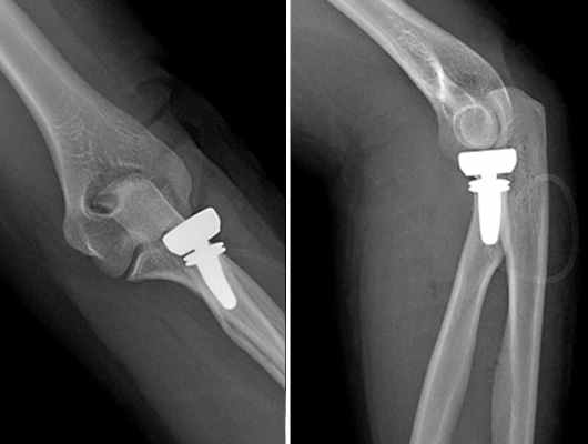 Рис. 7. Контрольные рентгенограммы