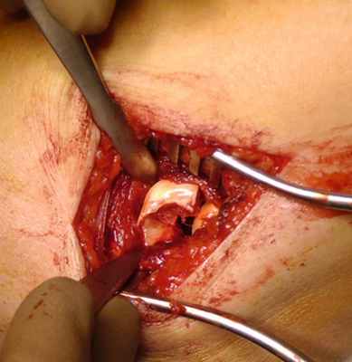 Рис. 3. Многооскольчатый перелом головки лучевой кости