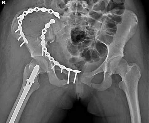 Остеосинтез костей таза при их переломах и повреждениях