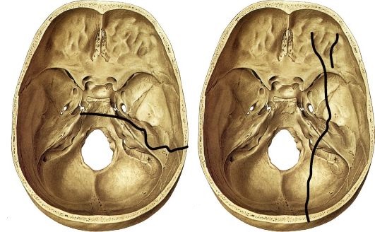 ПЕРЕЛОМ ПИРАМИДЫ ВИСОЧНОЙ КОСТИ.jpeg