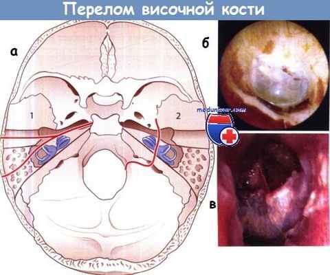 Перелом височной кости