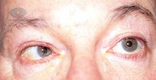 подвижность глазного яблока