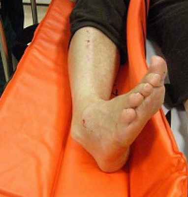 Фото Перелом голени