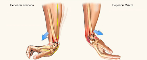 Перелом кисти 2