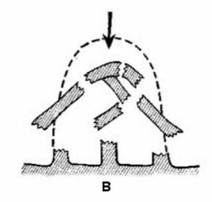 Перелом костей носа