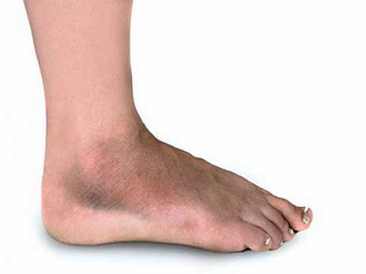 Фото Перелом стопы