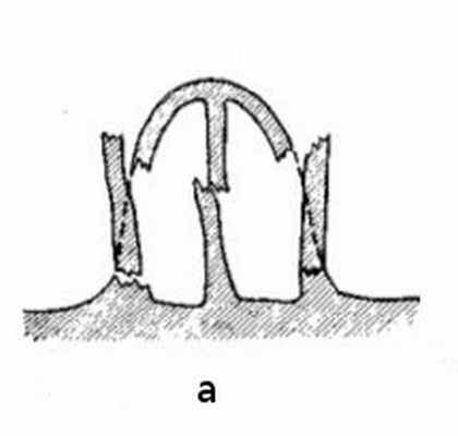 Перелом костей носа