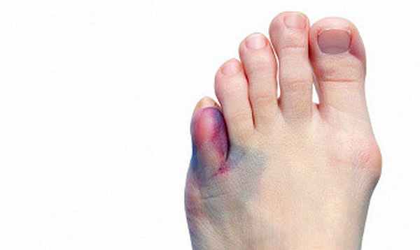 Фото Перелом пальца на ноге