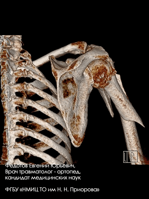 Перелом проксимального отдела плечевой кости