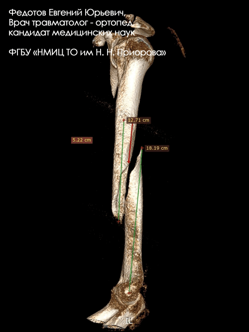 Перелом диафиза плечевой кости