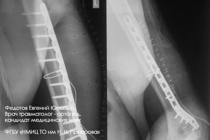 Перелом плечевой кости лечение