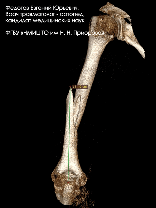 Перелом диафиза плечевой кости