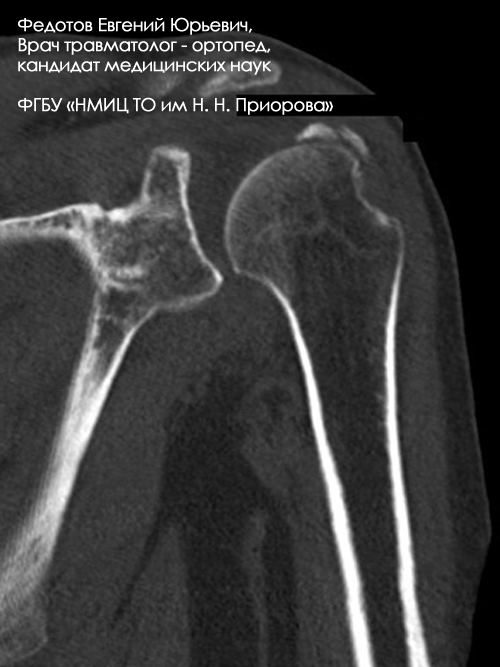Перелом большого бугорка плечевой кости