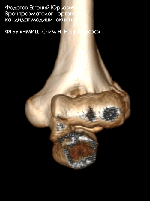 Перелом дистального отдела плечевой кости