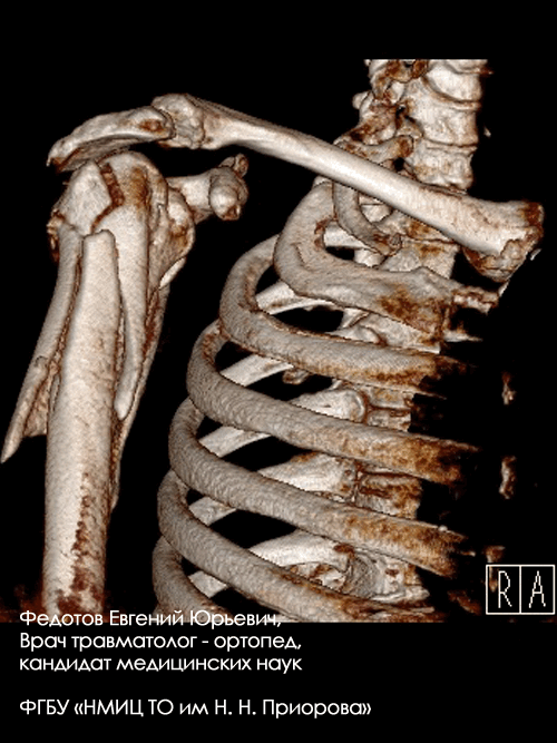 Перелом проксимального отдела плечевой кости