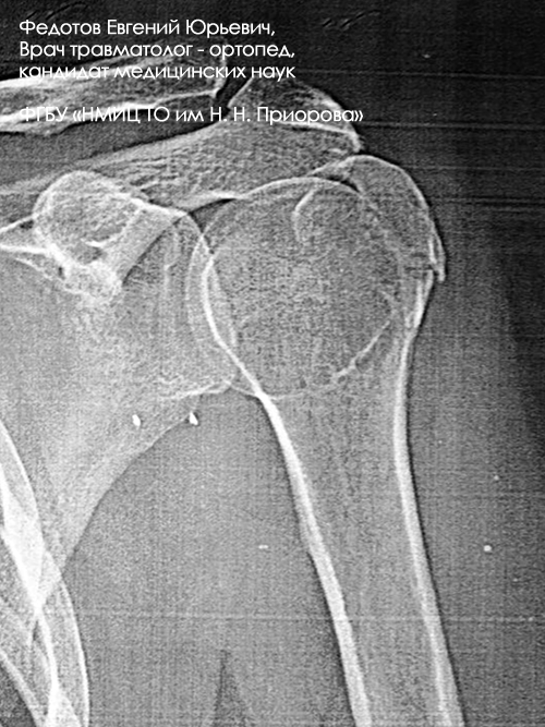 Перелом большого бугорка плечевой кости