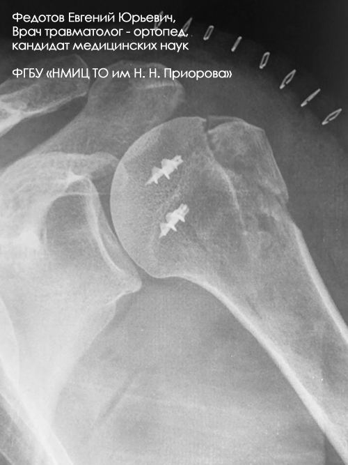 Перелом плечевой кости лечение