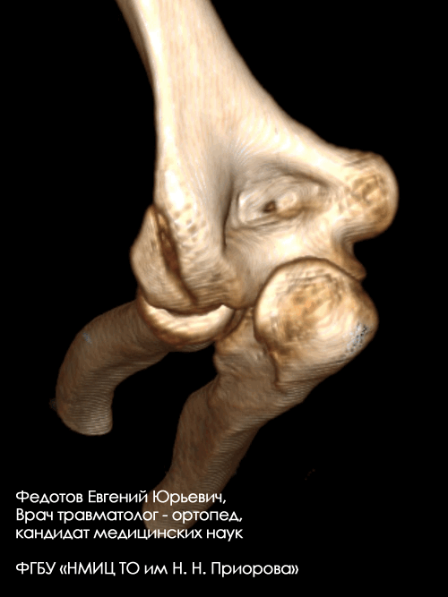Перелом дистального отдела плечевой кости
