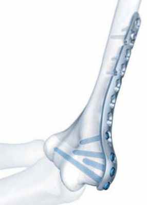 Перелом плеча