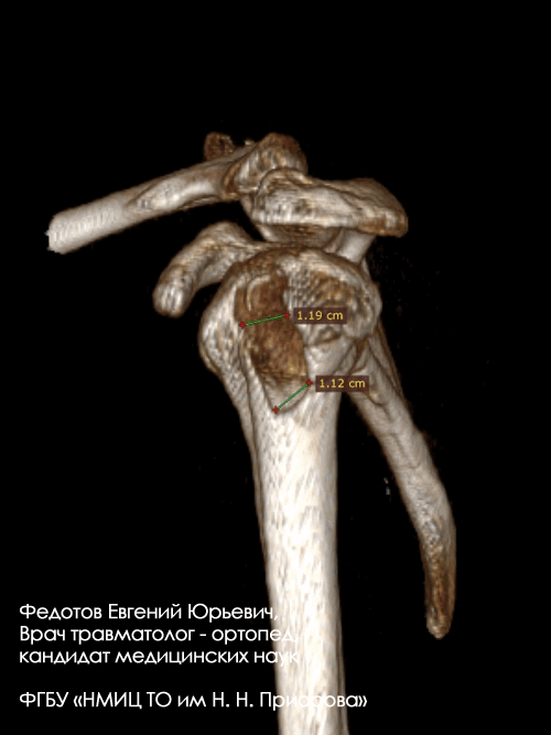 Перелом большого бугорка плечевой кости