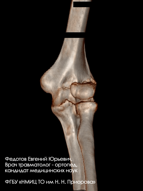 Перелом плечевой кости