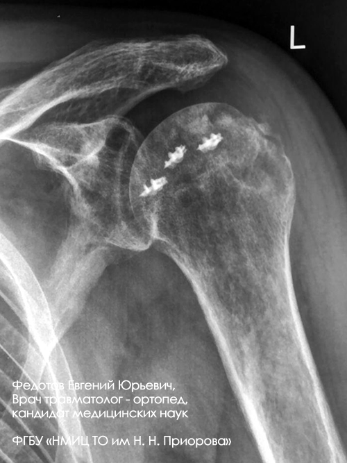 Перелом плечевой кости лечение