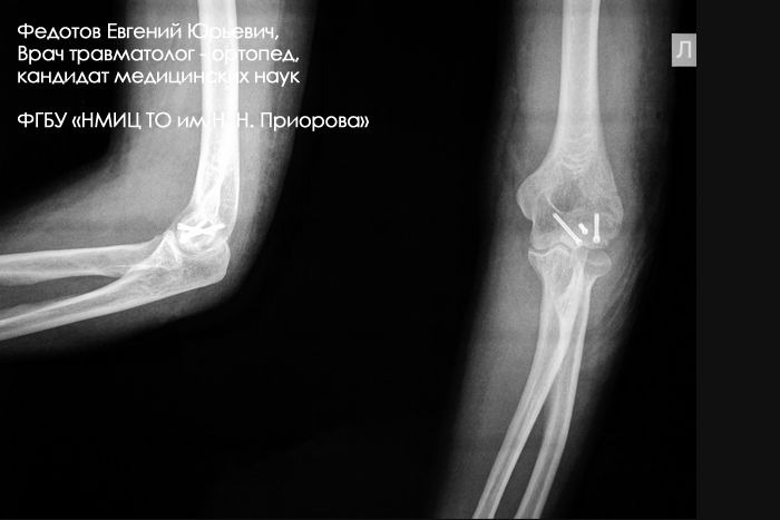 Перелом плечевой кости лечение