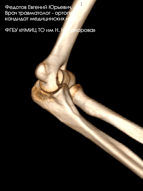 Перелом дистального отдела плечевой кости