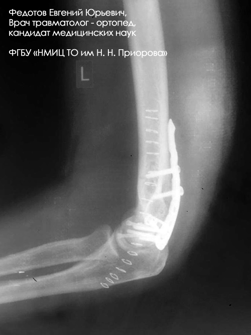 Перелом плечевой кости лечение