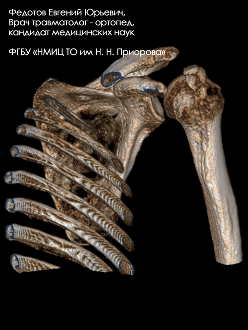 Перелом большого бугорка плечевой кости