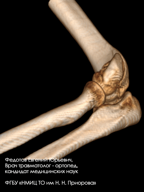 Перелом дистального отдела плечевой кости