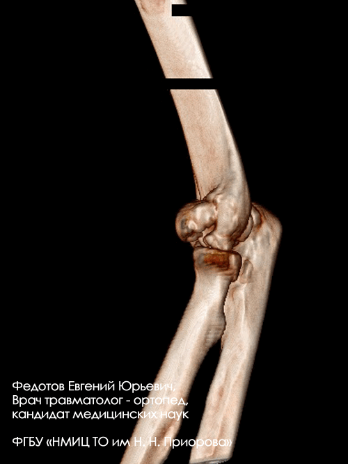 Перелом плечевой кости