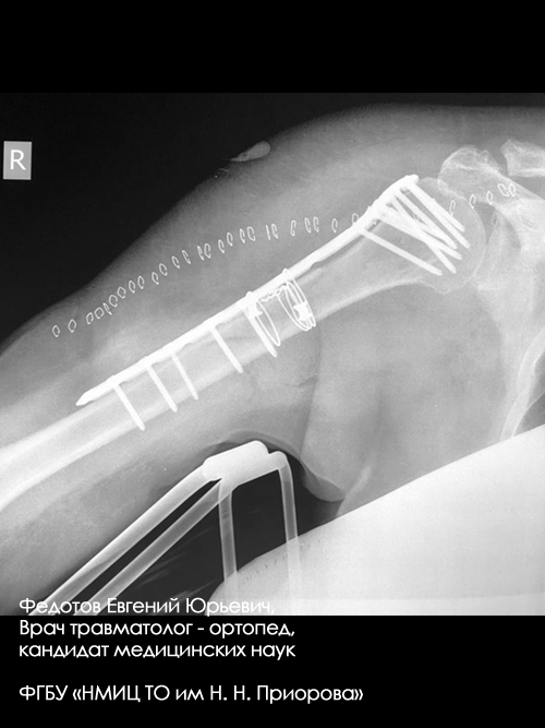 Перелом плечевой кости лечение