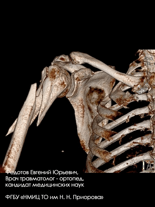 Перелом проксимального отдела плечевой кости