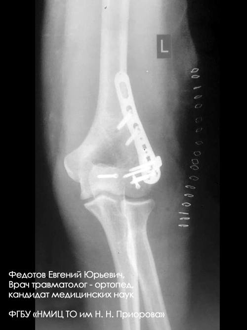 Перелом плечевой кости лечение