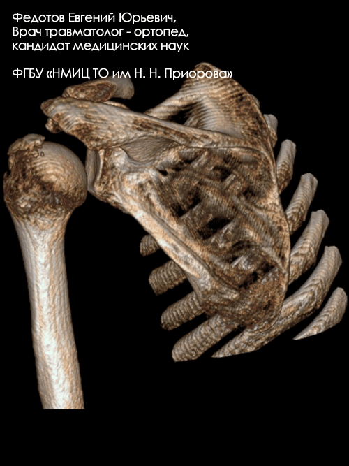 Перелом большого бугорка плечевой кости