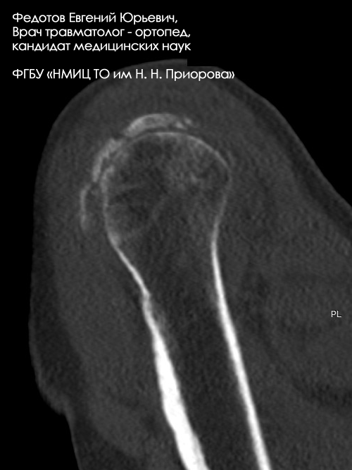 Переломплечевой кости