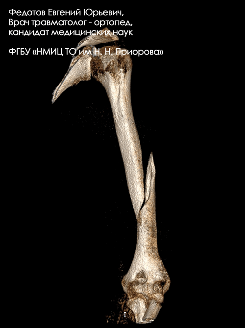 Перелом диафиза плечевой кости