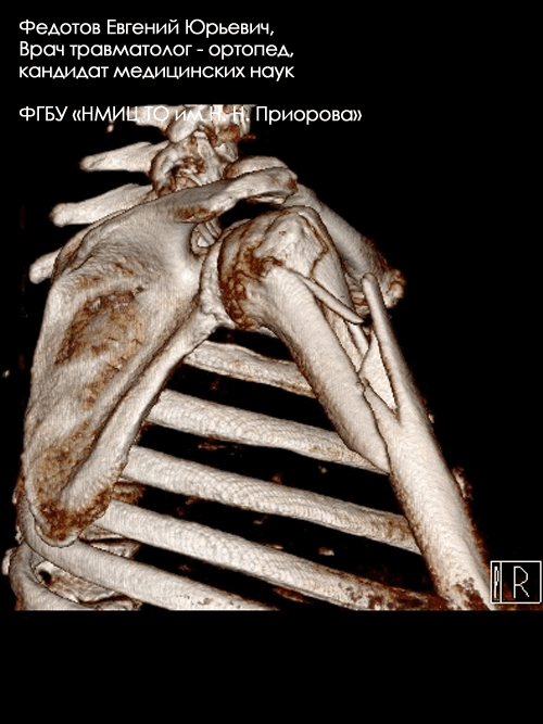Перелом проксимального отдела плечевой кости