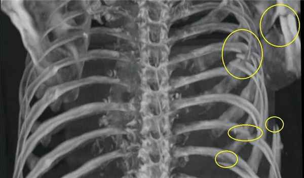 рентген переломов ребер