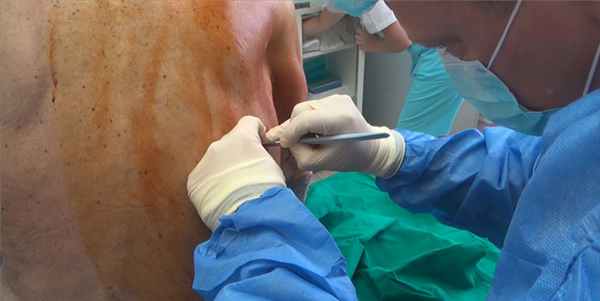 дренирование плевральной полости