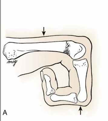 Перелом шейки