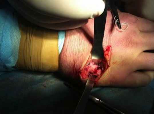 Оперперелом