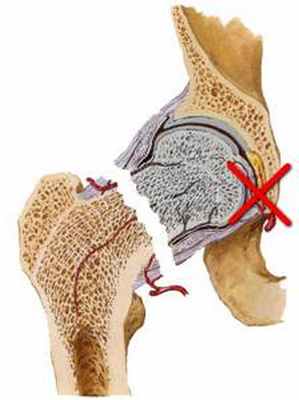 Перелом “шейки бедра” – симптомы, лечение, реабилитация
