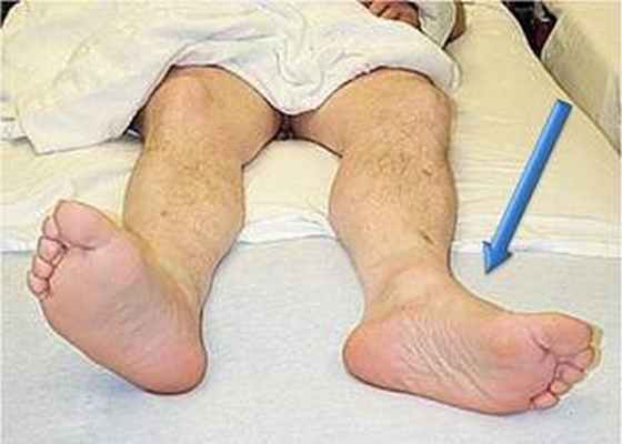 Перелом “шейки бедра” – симптомы, лечение, реабилитация