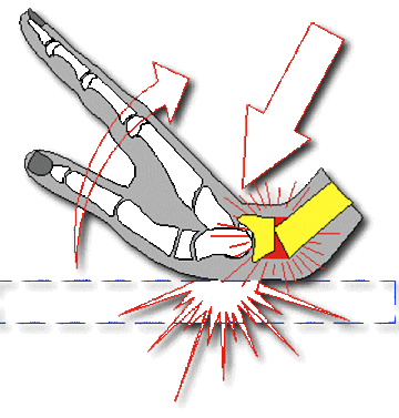 Фото Перелом запястья руки