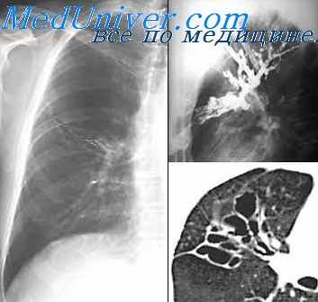легочное кровотечение