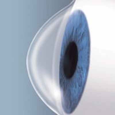 Причины возникновения и диагностика кератоконуса - Центра глазной хирургии по лечению глаз, коррекции и восстановлению зрения при помощи лазера.